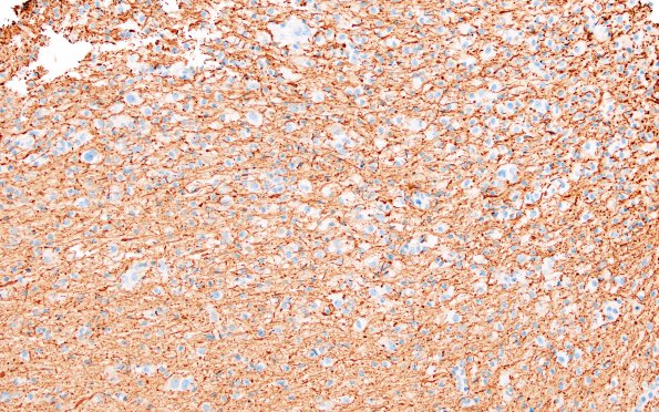 2L2 Inflammatory Demyelination (Case 2) Area C GM edge 20X NF 1