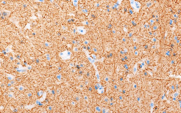 2L3 Inflammatory Demyelination (Case 2) Area C GM edge 40X NF 1