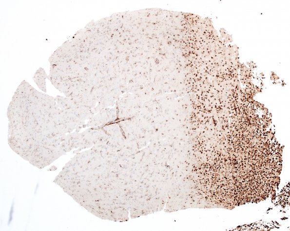 2M1 Inflammatory Demyelination (Case 2) Area C GM edge 4X CD68