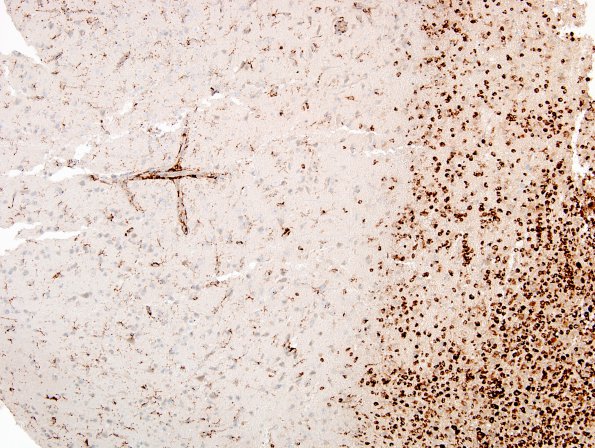 2M2 Inflammatory Demyelination (Case 2) Area C 10X CD68 1A