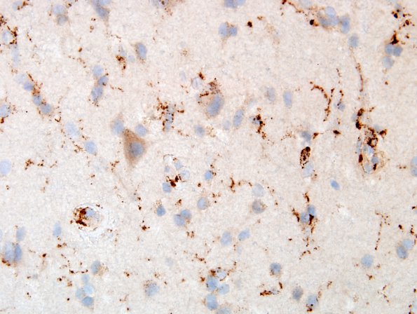 2M3 Inflammatory Demyelination (Case 2) Area D CD68 1