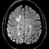 3A1 Inflammatory Demyelinating Process (Case 3) FLAIR 1 copy - Copy