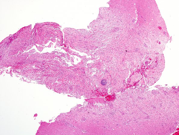 3B1 Inflammatory Demyelinating Process (Case 3) 1 H&E 4X