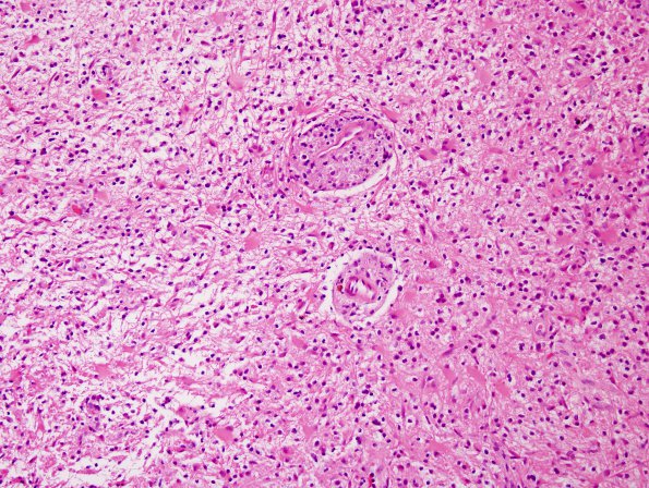 3B2 Inflammatory Demyelinating Process (Case 3) H&E 2