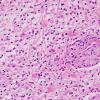 3B3 Inflammatory Demyelinating Process (Case 3) H&E 1