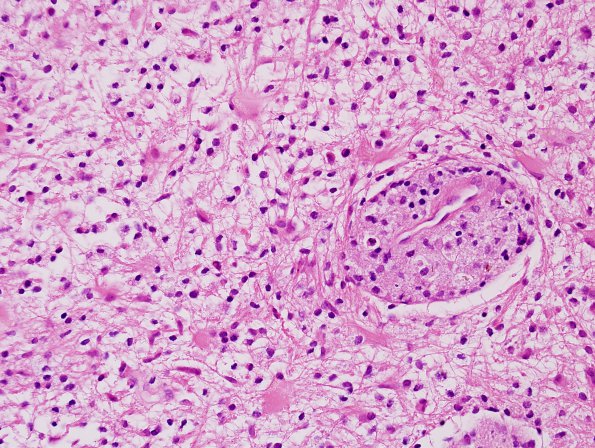 3B3 Inflammatory Demyelinating Process (Case 3) H&E 1