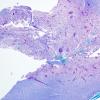 3C1 Inflammatory Demyelinating Process (Case 3) 1 LFB-PAS 4X