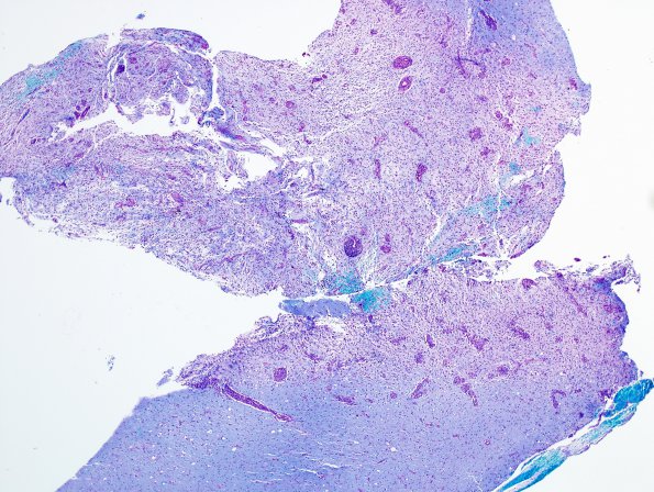 3C1 Inflammatory Demyelinating Process (Case 3) 1 LFB-PAS 4X