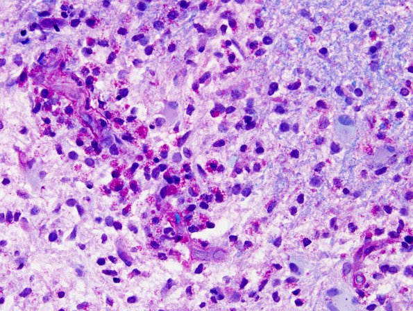 3C2 Inflammatory Demyelinating Process (Case 3) LFB-PAS 1