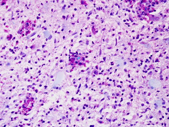 3C3 Inflammatory Demyelinating Process (Case 3) LFB-PAS 2