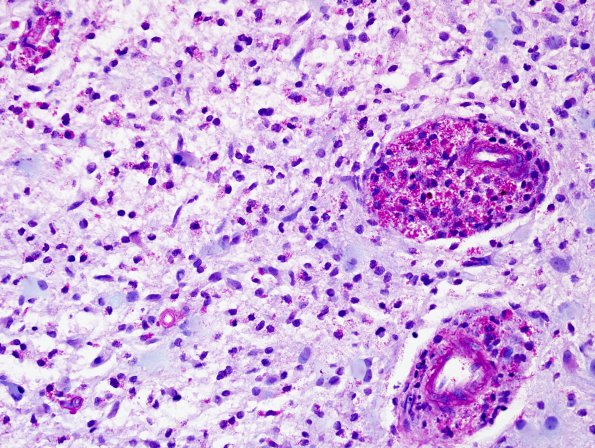 3C4 Inflammatory Demyelinating Process (Case 3) LFB-PAS 3