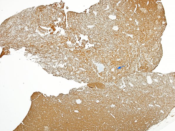 3D1 Inflammatory Demyelinating Process (Case 3) NF 4X Location of close-up cop