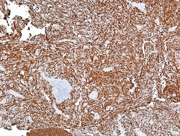 3D2 Inflammatory Demyelinating Process (Case 3) NF 2