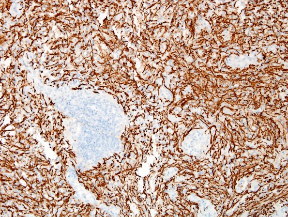 3D3 Inflammatory Demyelinating Process (Case 3) NF 3