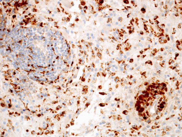 3E2 Inflammatory Demyelinating Process (Case 3) CD68