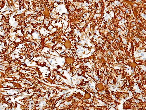 3F2 Inflammatory Demyelinating Process (Case 3) GFAP 1