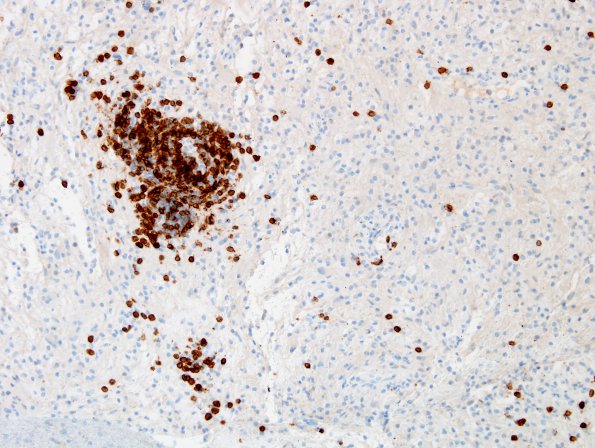 3G2 Inflammatory Demyelinating Process (Case 3) CD3