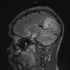 4A1 Inflammatory Demyelination (Case 4) FLAIR 1 - Copy