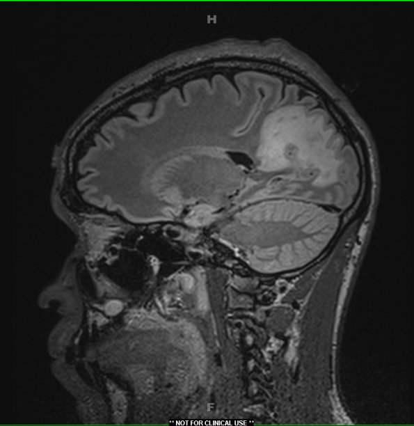 4A1 Inflammatory Demyelination (Case 4) FLAIR 1 - Copy