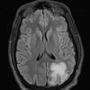 4A2 Inflammatory Demyelination (Case 4) FLAIR 2 - Copy