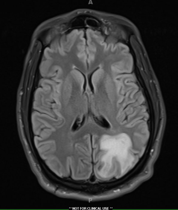 4A2 Inflammatory Demyelination (Case 4) FLAIR 2 - Copy