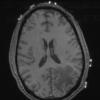 4A3 Inflammatory Demyelination (Case 4) T1 no Contrast 2 - Copy