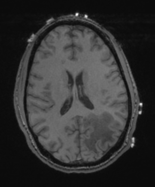 4A3 Inflammatory Demyelination (Case 4) T1 no Contrast 2 - Copy