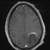 4A4 Inflammatory Demyelination (Case 4) T1 With Contrast 4 - Copy