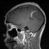 4A5 Inflammatory Demyelination (Case 4) T1 With Contrast 6 - Copy