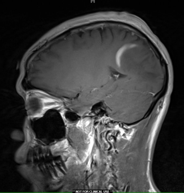 4A5 Inflammatory Demyelination (Case 4) T1 With Contrast 6 - Copy