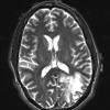 4A6 Inflammatory Demyelination (Case 4) T2 With Contrast 1 (2) - Copy