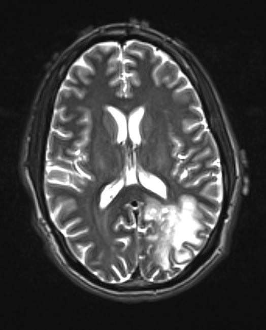 4A6 Inflammatory Demyelination (Case 4) T2 With Contrast 1 (2) - Copy