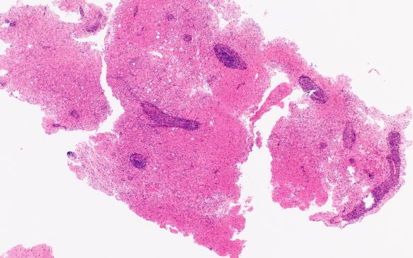 4B1 Inflammatory Demyelination (Case 4) H&E 4X 3 HC