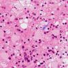 4B3 Inflammatory Demyelination (Case 4) H&E 60X copy