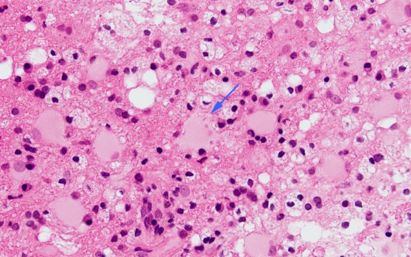 4B3 Inflammatory Demyelination (Case 4) H&E 60X copy