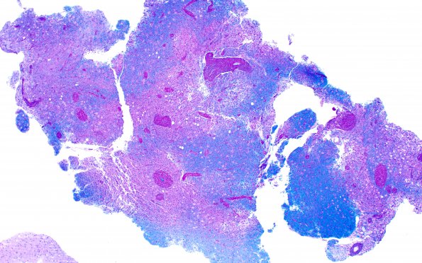 4C1 Inflammatory Demyelination (Case 4) LFB-PAS 4X 1