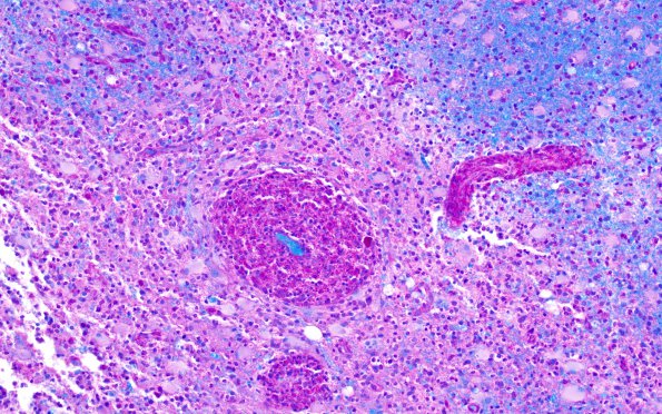 4C2 Inflammatory Demyelination (Case 4) LFB-PAS 20X 1