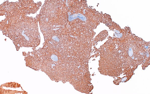 4D1 Inflammatory Demyelination (Case 4) NF 4X