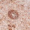 4E2 Inflammatory Demyelination (Case 4) CD68 20X 3