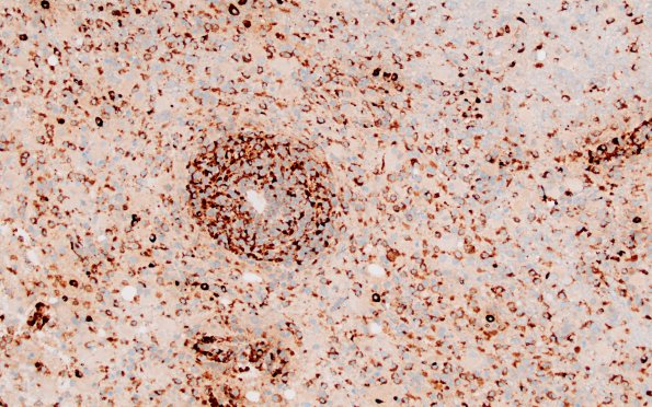 4E2 Inflammatory Demyelination (Case 4) CD68 20X 3