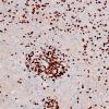 4F2 Inflammatory Demyelination (Case 4) CD3 20X 1