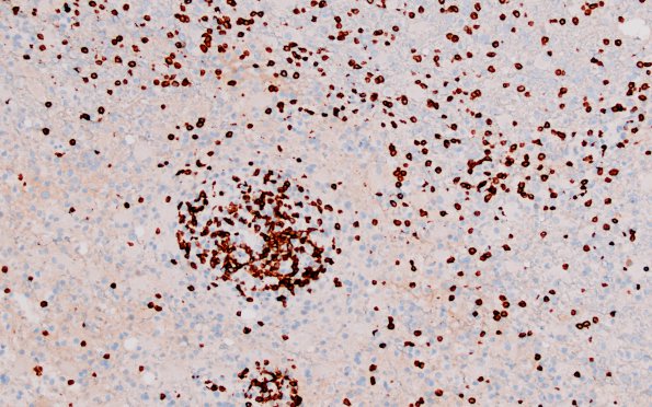 4F2 Inflammatory Demyelination (Case 4) CD3 20X 1