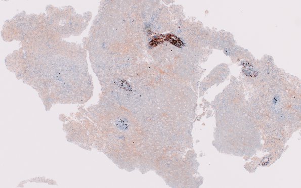 4G1 Inflammatory Demyelination (Case 4) CD20 4X