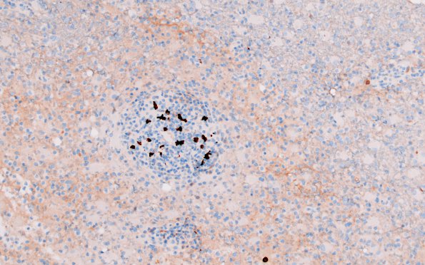 4G2 Inflammatory Demyelination (Case 4) CD20 20X