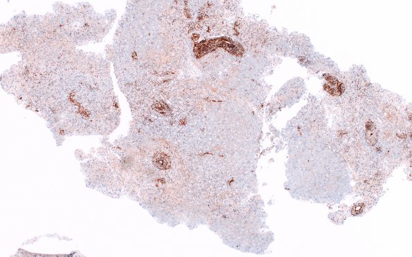 4I1 Inflammatory Demyelination (Case 4) SMA 4X