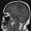 5A2 Inflammatory demyelination (Case 5) T1 2