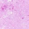 5B1 Inflammatory Demyelination (Case 5) H&E 1