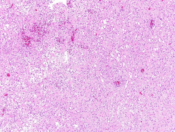 5B1 Inflammatory Demyelination (Case 5) H&E 1