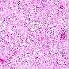 5B2 Inflammatory Demyelination (Case 5) H&E 2