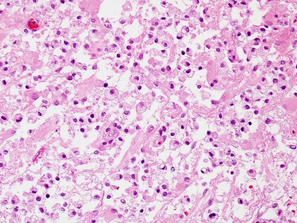 5B3 Inflammatory Demyelination (Case 5) H&E 5